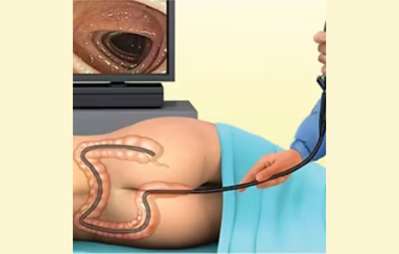 Colonoscopy